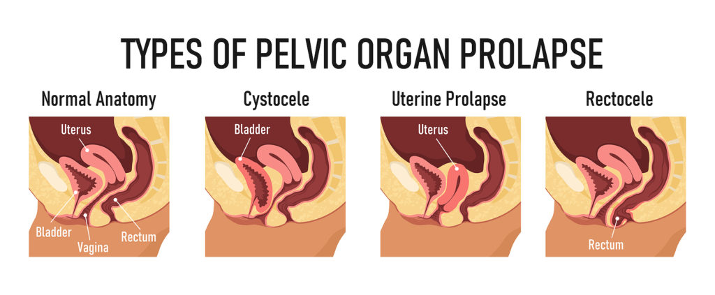 pelvic organs, female reproductive system, vagina diagram,menstrual cups cause prolapse