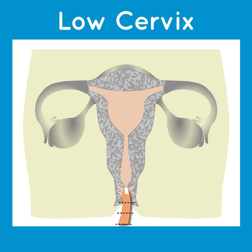 Superior Quality Low Cervix Menstrual Cup SochGreen